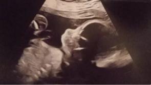 Donegal Mum's plea for support as she fights to give unborn baby Theo the best chance at life