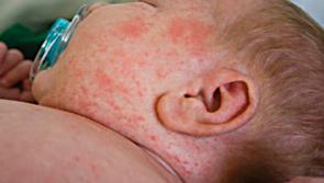 Parents urged to ensure children and young people are vaccinated against measles