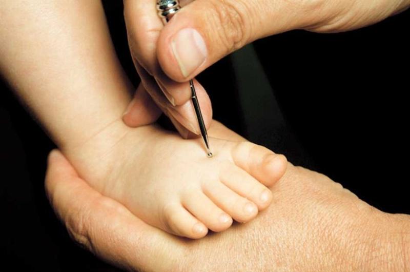 Acupuncture