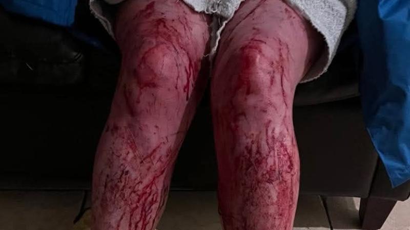 Lough Swilly RNLI issue warning after woman suffers bout of hypothermia in water